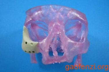 3D打印面部植入医疗器械聚合物材料